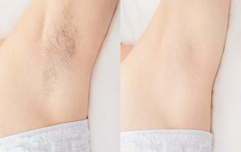 Unbehaarte und behaarte Achseln nebeneinander verglichen.